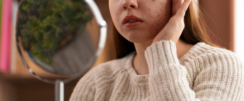 BRUFOLI e ACNE? Che imbarazzo.. Non solo un problema di pelle...